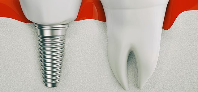 implant supported dentures