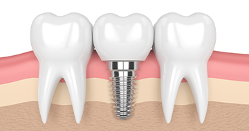 How long do dental implants last