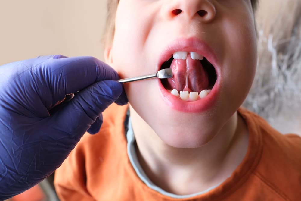 Frenectomy