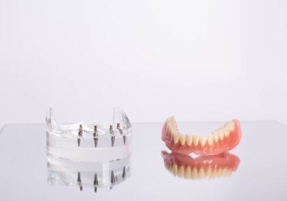 Affordable Implant-Supported Over-Dentures in Narre Warren South and Ferntree Gully