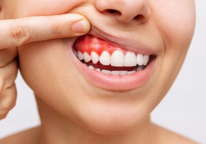 Periodontal Treatment at Crown Dental Group in Narre Warren South and Ferntree Gully